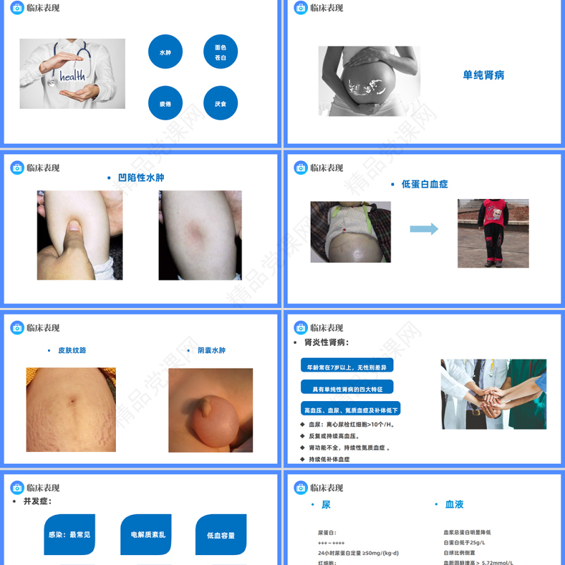 2024原发性肾病综合征PPT简约插画风医疗原发性肾病综合征护理查房模板课件